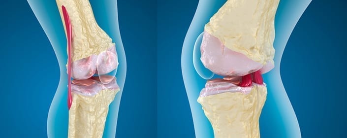 bone marrow stem cell cartilage