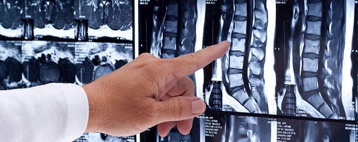 stem cells healing spine spinal