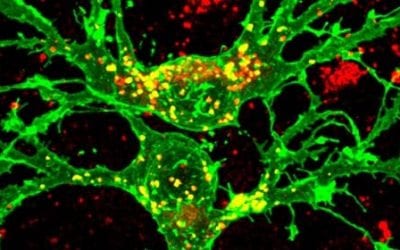 Umbilical Cord Stem Cells Appear Safe and Effective for Multiple Sclerosis
