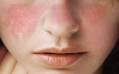 Lupus – What are the Signs and Symptoms?