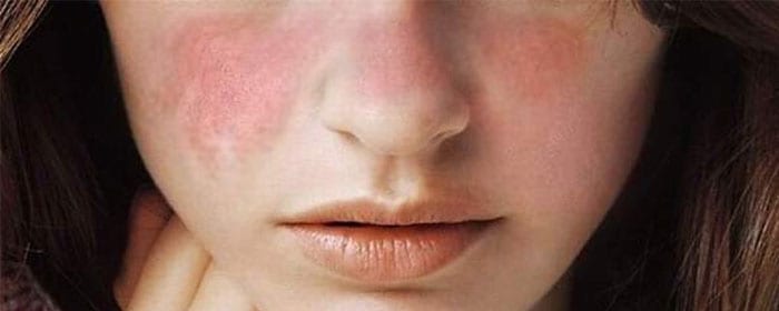 Lupus – What are the Signs and Symptoms