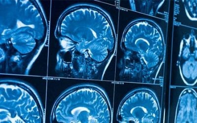 Stem Cells for Traumatic Brain Injury