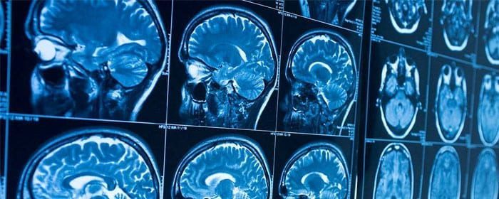 Stem Cells for Traumatic Brain Injury