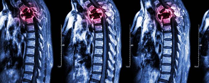 Autologous Mesenchymal Stem Cell Transplantation for Spinal Cord Injury