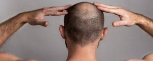 Same Day Stem Cell Treatment for Pattern Baldness