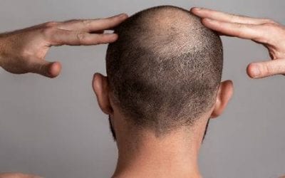 Same Day Stem Cell Treatment for Pattern Baldness