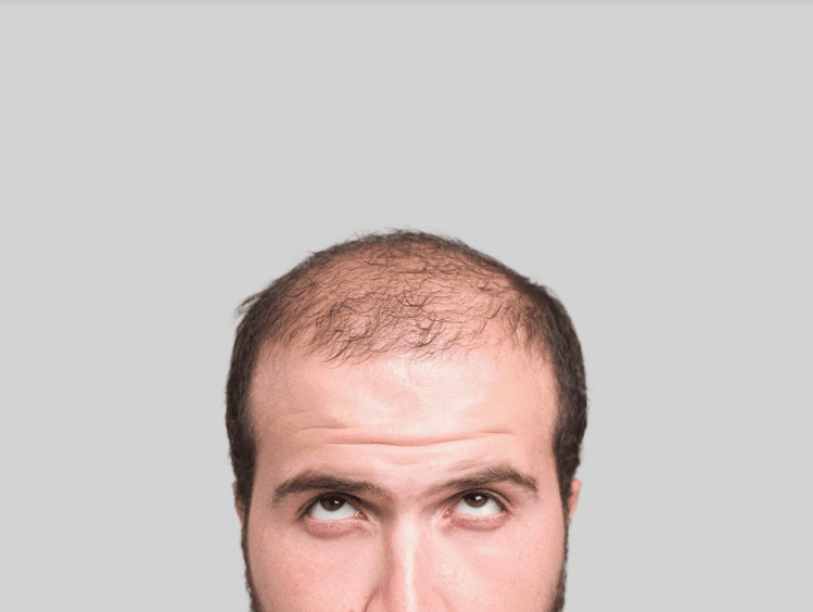 Considering Stem Cell Hair Restoration