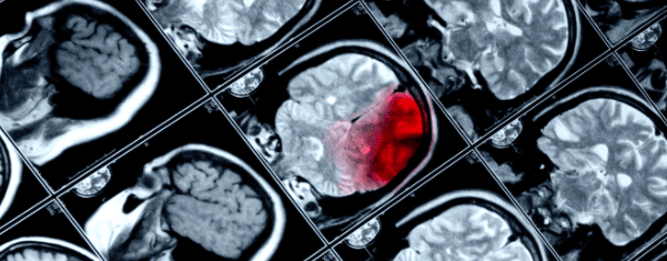 Can Stem Cells Repair Traumatic Brain Injury?
