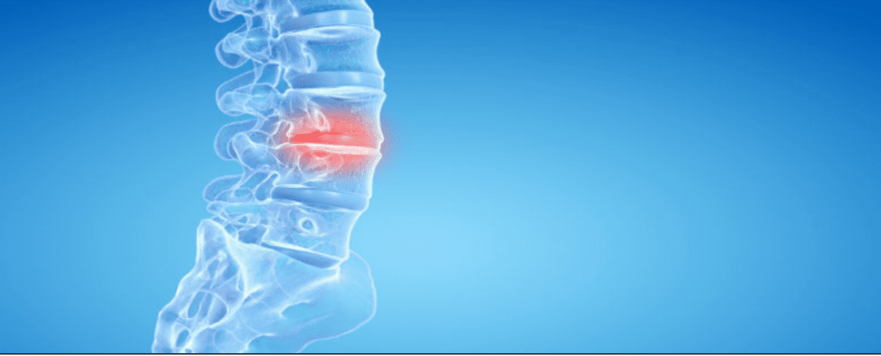 What’s the Best Treatment for Degenerative Disc Disease?