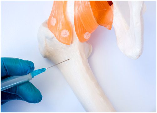 bone-marrow-aspirate What Is Stem Cell Therapy?