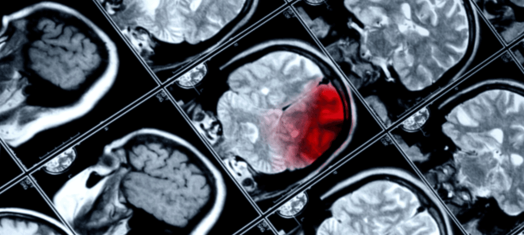 What Are Examples of TBI? | Stemedix | Regenerative Medicine