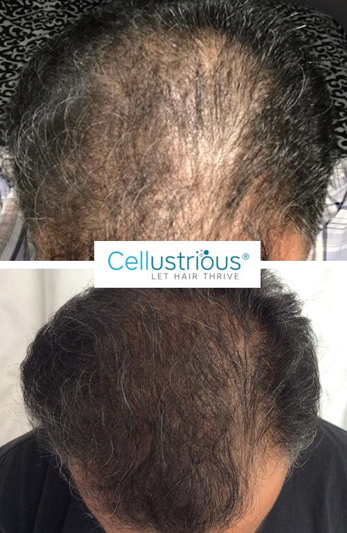 before-after-2 Chelation Therapy