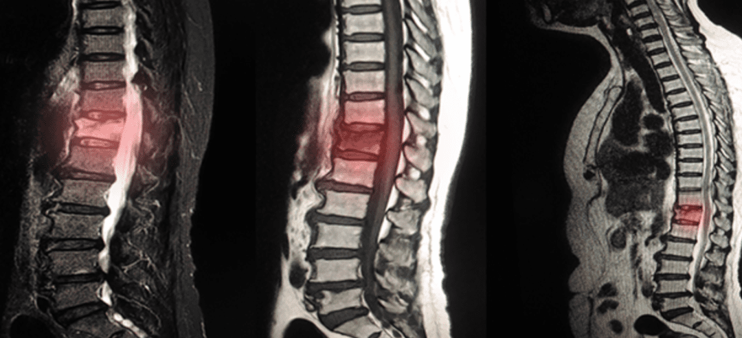 Things to Avoid with Degenerative Disc Disease