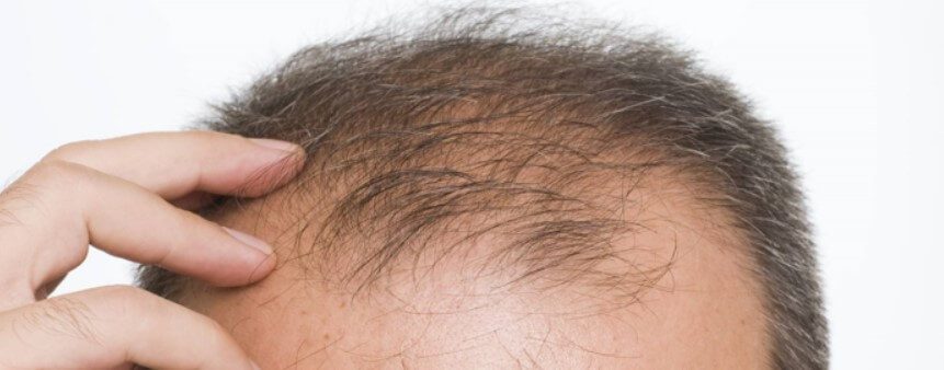Regenerative Medicine for Hair Loss. Healthy Regrowth