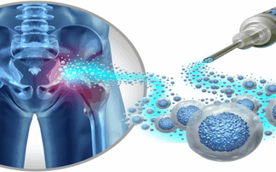 Exploring the Healing Potential of Umbilical Cord Stem Cells for Early-Stage Osteonecrosis of the Femoral Head