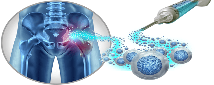 Exploring the Healing Potential of Umbilical Cord Stem Cells for Early-Stage Osteonecrosis of the Femoral Head