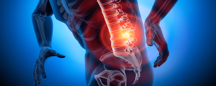 Fibrin Sealant Injections: A Promising Regenerative Approach for Chronic Low Back Pain 