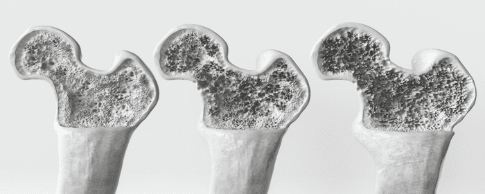 Stem Cell Therapy for Osteoporosis: Exploring the Future of Bone Health