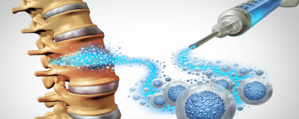 Illustration showing a syringe injecting stem cells into a spinal cord to promote regeneration and healing.