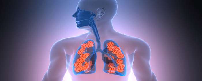 Innovations in Pulmonary Care: How MSCs Could Transform IPF Treatment